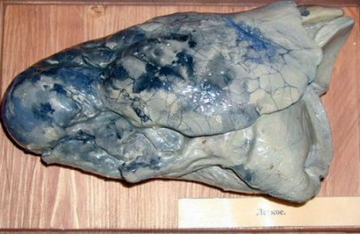 Легкое курильщика